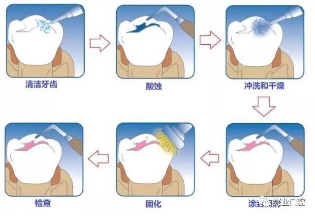 窝沟封闭.jpg